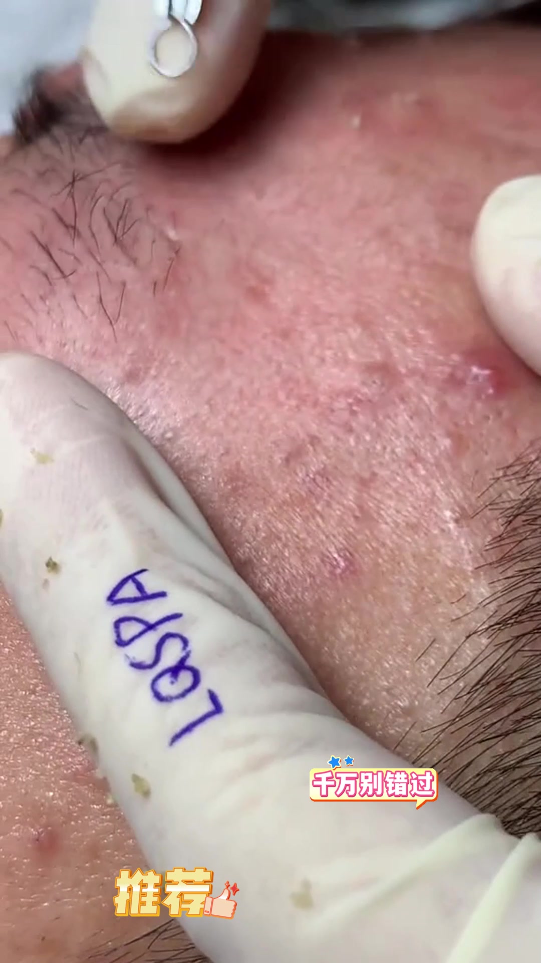 挤痘痘医生破解版(挤痘痘游戏第二关怎么过)